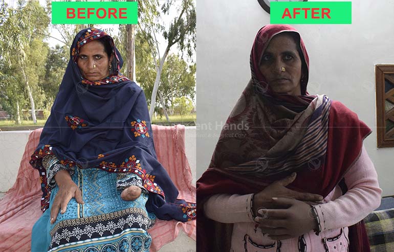 Mai Hanifan artificial hand has helped her resume her normal life