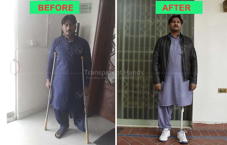 Siraj-udin is Happy with His Prosthesis