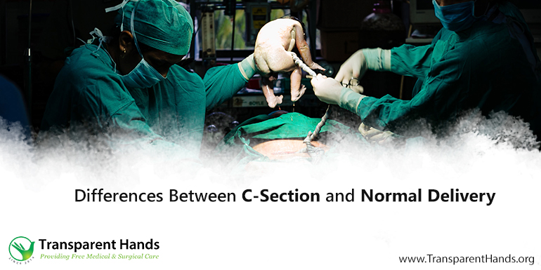 Differences Between C-Section and Normal Delivery