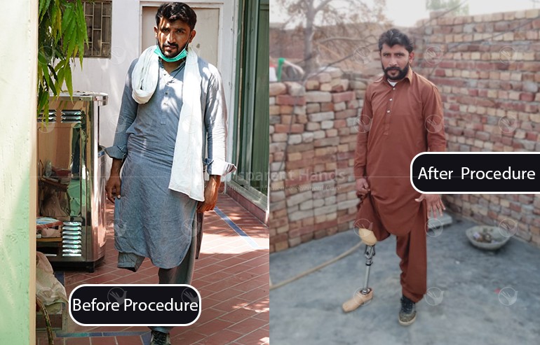 Muhammad Tufail prosthetic leg