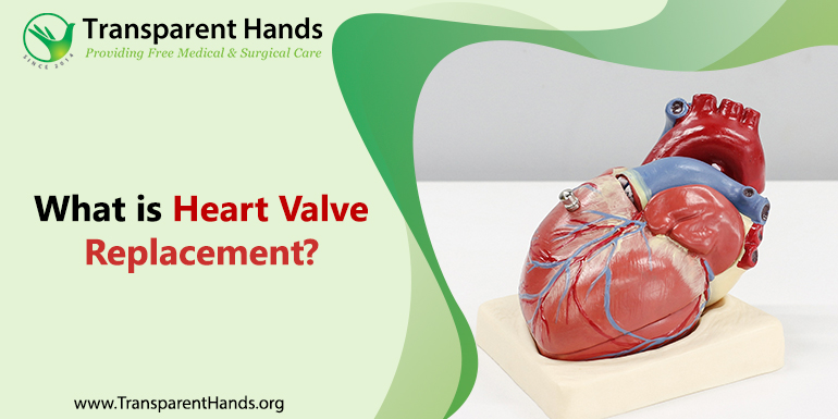 What is Heart Valve Replacement (1)