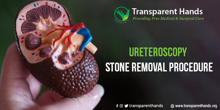 Ureteroscopy Stone Removal Procedure