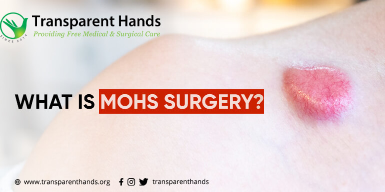 Mohs procedure is performed to treat skin cancer. Thin layers of skin are removed in this medical procedure.