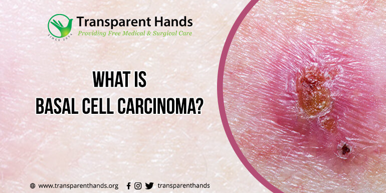 What is Basal Cell Carcinoma