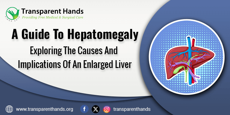 hepatomegaly-Enlarged Liver