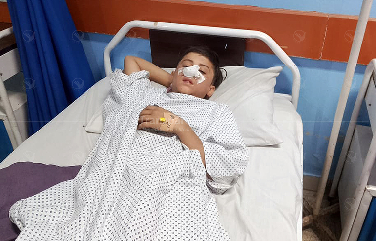 Rehman’s Septoplasty